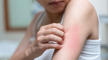 eczema relief