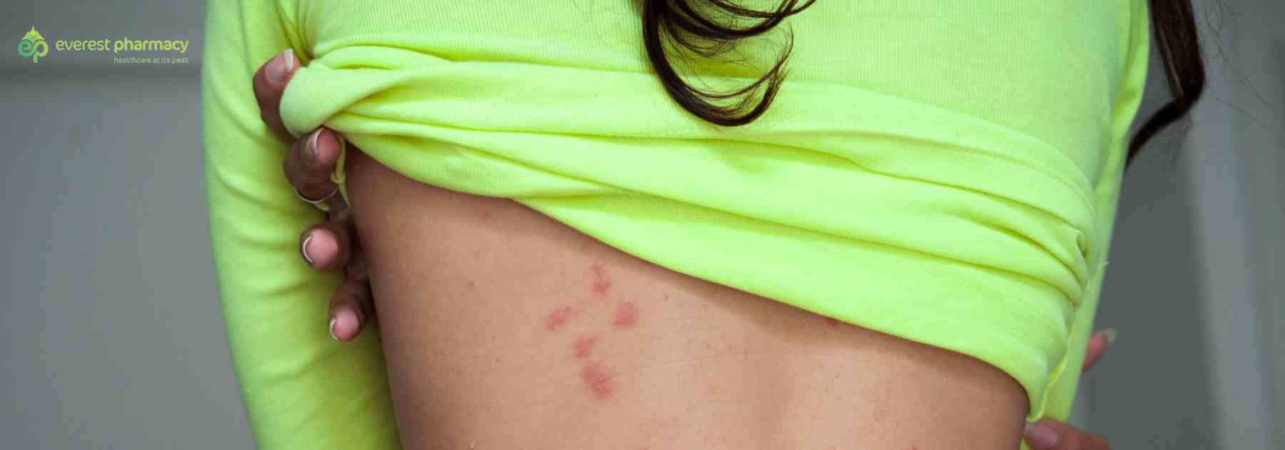 infected insect bite