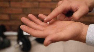 Cryotherapy vs wart removal creams