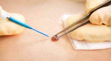 How to remove skin tags without scarring